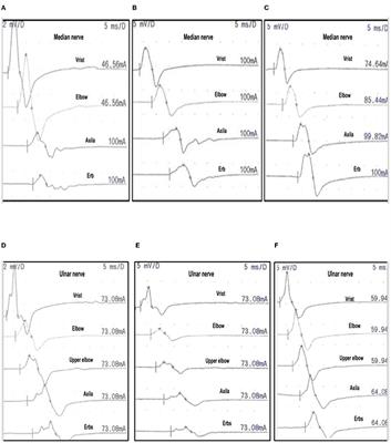 Nodopathies in the Early Diagnosis of Axonal Forms of Guillain-Barré Syndrome
